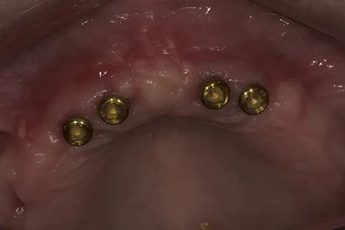 Implant overdenture abutments healed in situ 4 weeks later