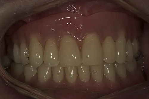After treatment: An upper implant overdenture with bone regeneration