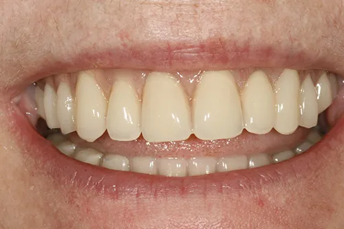 Smile of final dentures