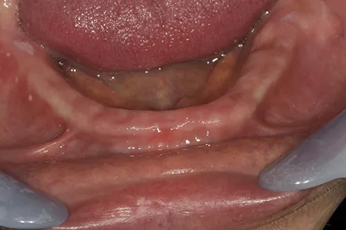 Before treatment: Adapting a lower denture to fit onto implants