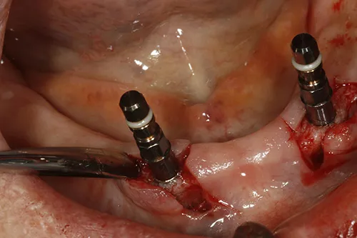 Implant fixtures placed