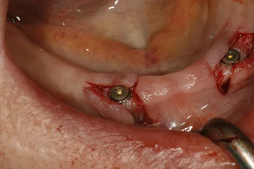 Healing abutments in place just prior to implants placed