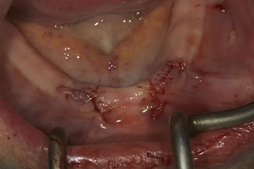 Surgical site closed and healed