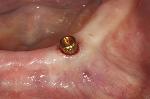 Implant overdenture placed lower left hand side