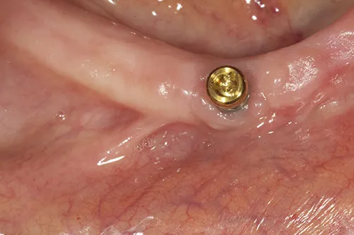 Implant overdenture abutment placed lower left side