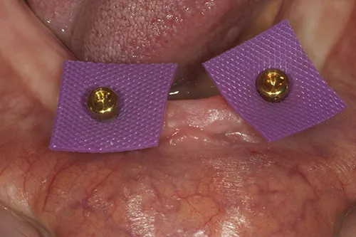 Implant overdenture abutments prepared for reline