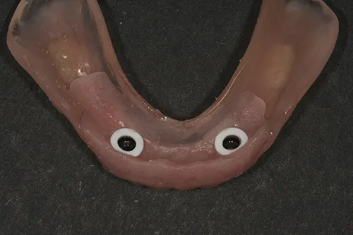 Fit surface of lower denture prepared for reline