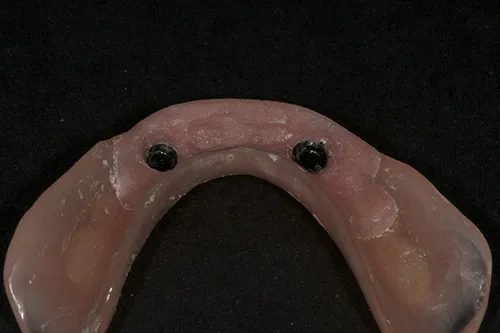 Implant overdenture relined