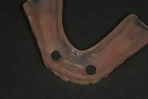 Implant overdenture fit surface polished