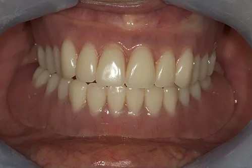Relationship of upper and lower dentures together