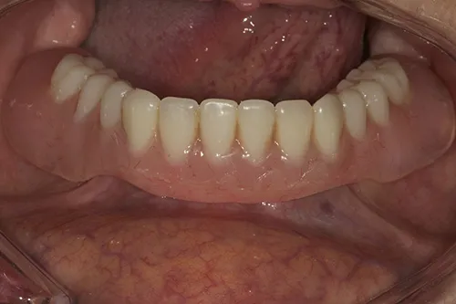 After treatment: Adapting a lower denture to fit onto implants