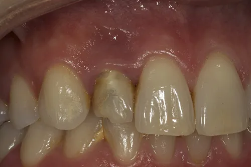Before treatment: Replacing an old crown with a single implant crown