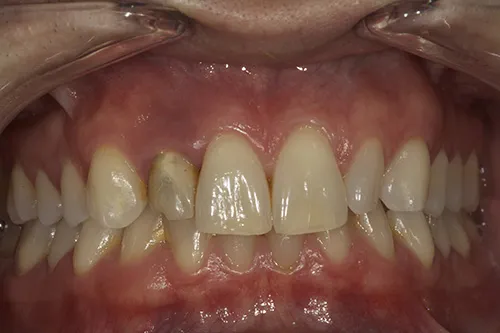 Pre-op old crown in situ with smile