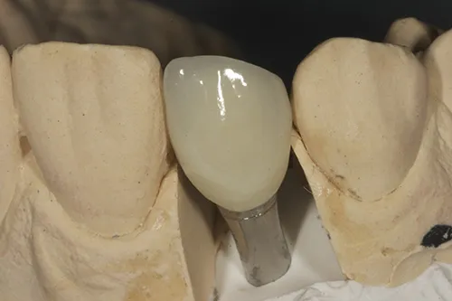 Permanent crown on model