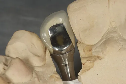 Permanent crown on model