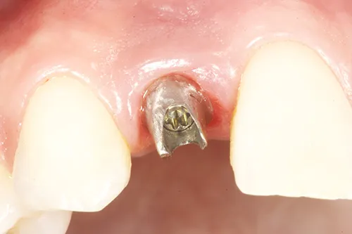 Permanent abutment tightened in situ