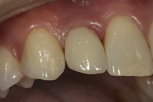 Permanent crown seated in situ