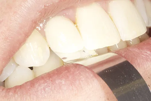 Bite checked of permanent crown