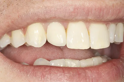 Post op smile of RHS