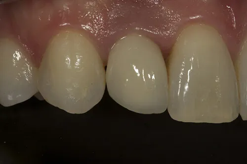 After treatment: Replacing an old crown with a single implant crown