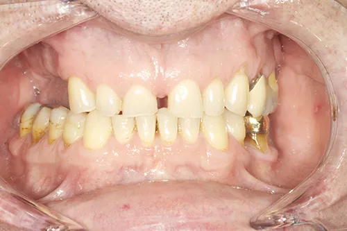 Before treatment: Restoring worn and missing teeth with implants and crowns
