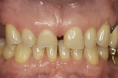 Close up preoperative of very worn teeth