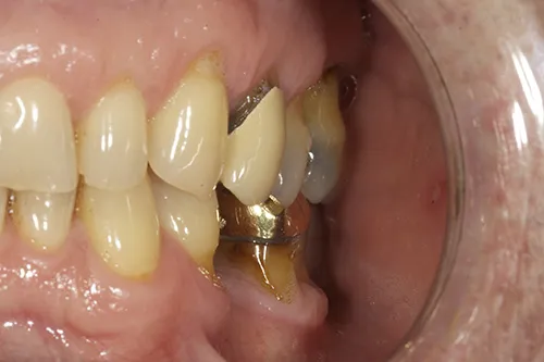 Left side retracted preoperative view