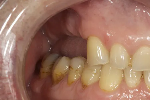Right side preoperative view of missing and worn teeth
