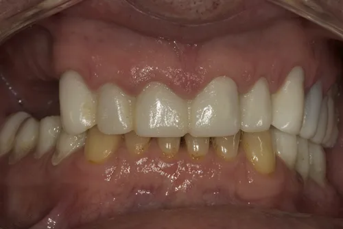 Provisional temporary crowns in situ after 3 months made from planned diagnostic wax up