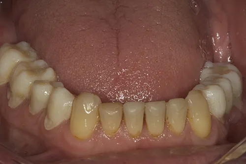 Lower arch provisional restorations made from diagnostic wax up