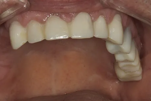 Upper arch provisional crowns made from diagnostic wax up