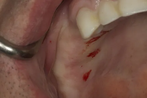 Preoperative site healed before implant placement