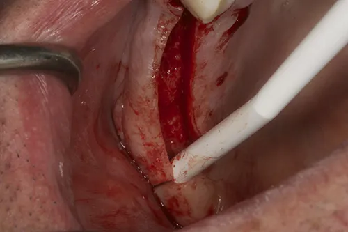 Gum reflected to expose implant bed