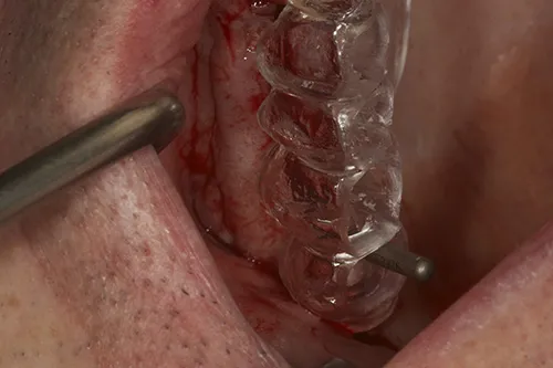 Surgical guide in situ to aid in correct implant positioning