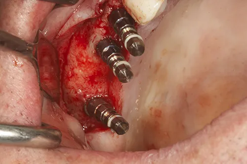Implants placed in situ with correct angulations