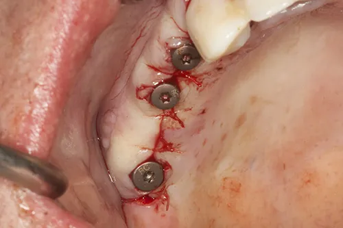 Healing abutments placed and implant site closed