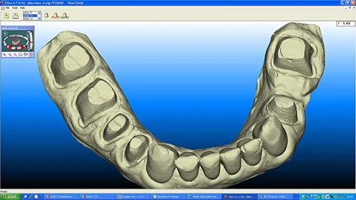iTero scan taken during the implant healing phase to make the lower crowns