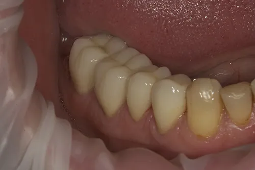 During implant healing phase lower right crowns constructed