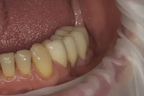 Lower left crowns fitted