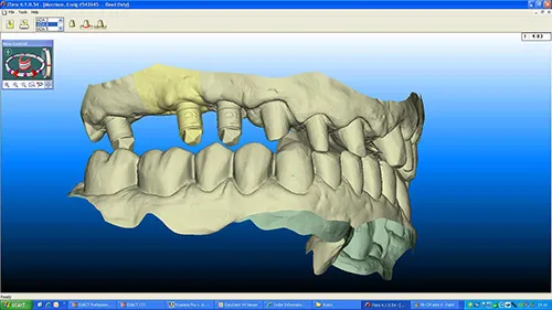 iTero digital scan of implant fixture scan bodies