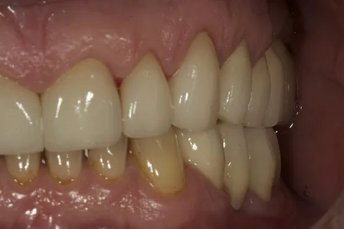 Upper left hand side crowns fitted and front crowns tried in situ