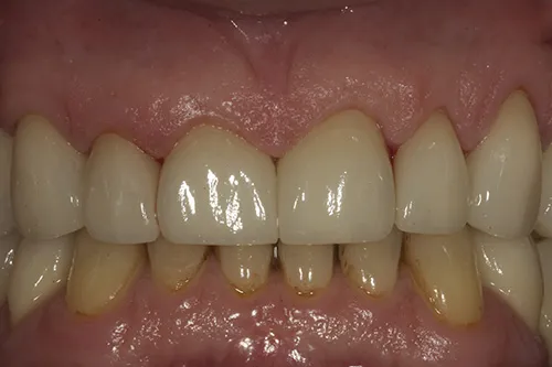 Upper front crowns tried in situ