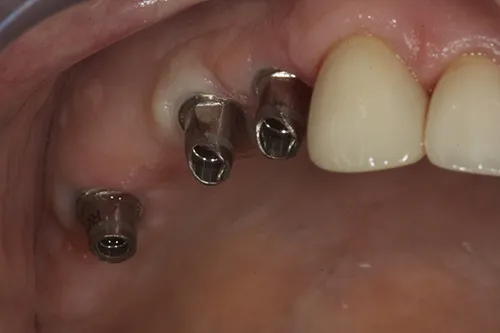 Implant fixture abutments connected from iTero model and scan