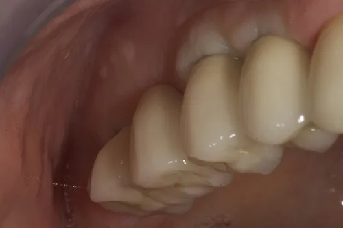 Retracted view of permanent implant crowns tried in situ