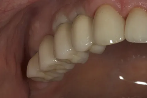 View of permanent implant restorations tried in