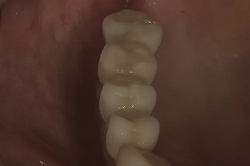 Chewing surface of implant restorations