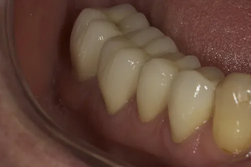 3 month review of lower right crowns