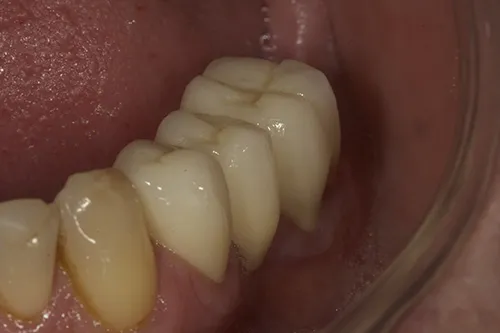 3 month review of lower left crowns