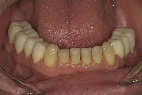 3 month review of lower restored teeth