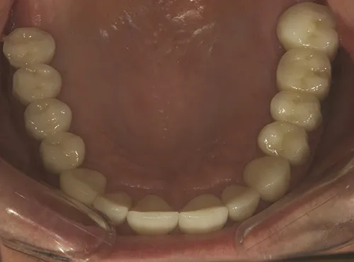 Mirror view of upper restored teeth